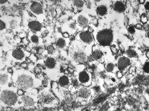 F,68y. | APUD carcinoma F,68y. | APUD carcinoma